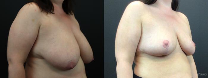 Before & After Breast Reduction Case 277 Right Oblique View in Glen Carbon, IL