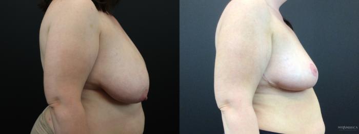 Before & After Breast Reduction Case 277 Right Side View in Glen Carbon, IL