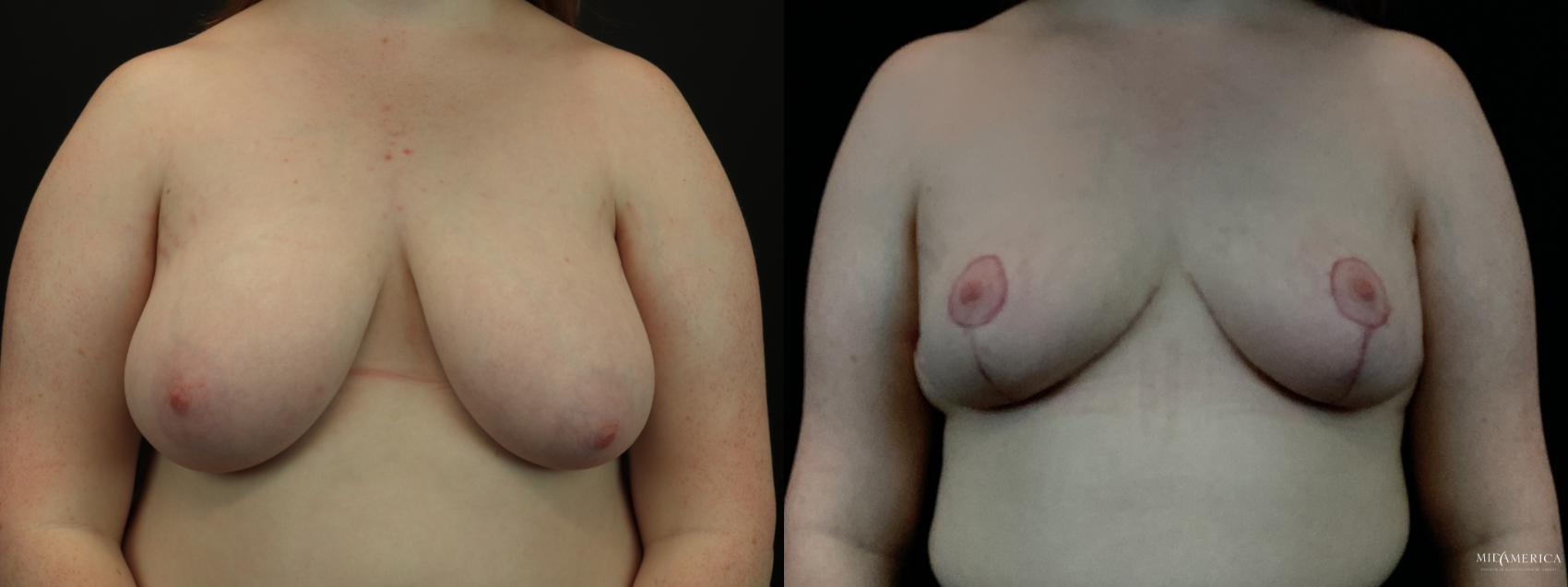 Before & After Breast Reduction Case 285 Front View in St. Louis, MO