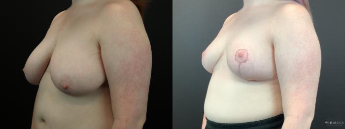 Before & After Breast Reduction Case 285 Left Oblique View in St. Louis, MO