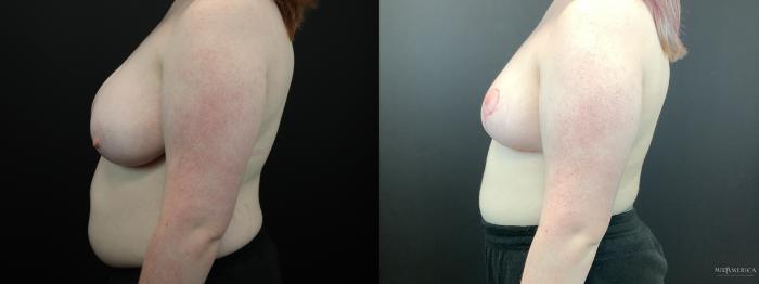Before & After Breast Reduction Case 285 Left Side View in St. Louis, MO