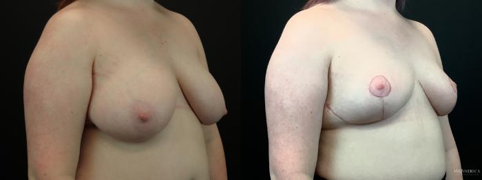 Before & After Breast Reduction Case 285 Right Oblique View in St. Louis, MO