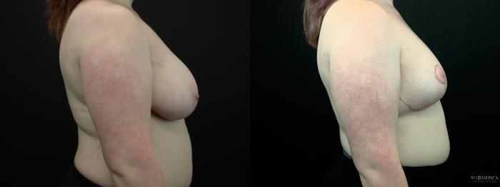 Before & After Breast Reduction Case 285 Right Side View in St. Louis, MO