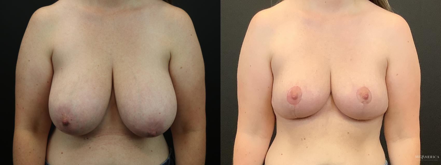Before & After Breast Reduction Case 287 Front View in St. Louis, MO