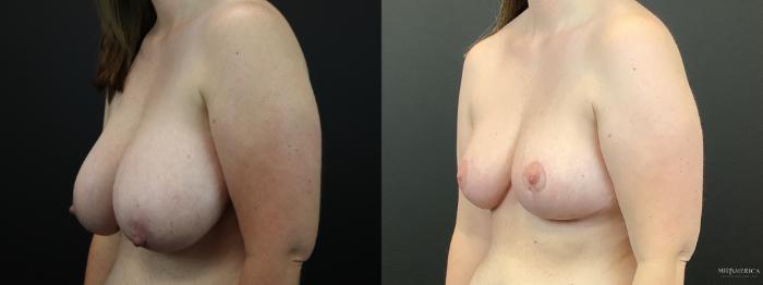 Before & After Breast Reduction Case 287 Left Oblique View in St. Louis, MO