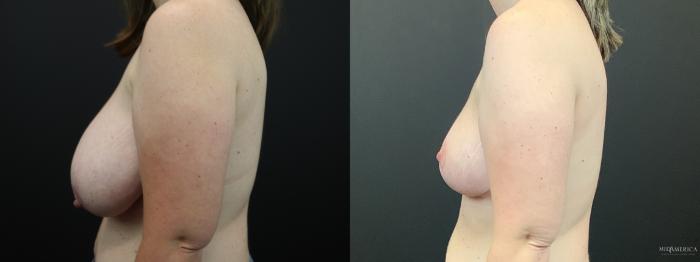 Before & After Breast Reduction Case 287 Left Side View in St. Louis, MO