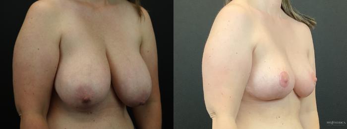 Before & After Breast Reduction Case 287 Right Oblique View in St. Louis, MO
