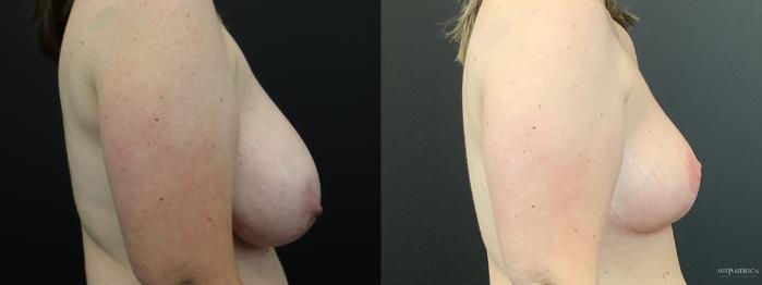 Before & After Breast Reduction Case 287 Right Side View in St. Louis, MO