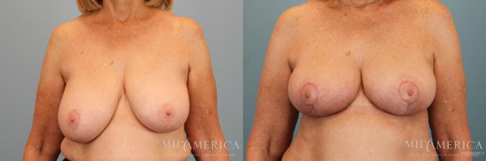 Before & After Breast Reduction Case 31 View #1 View in Glen Carbon, IL