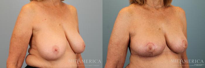Before & After Breast Reduction Case 31 View #2 View in Glen Carbon, IL