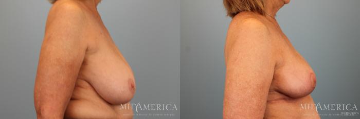 Before & After Breast Reduction Case 31 View #3 View in Glen Carbon, IL