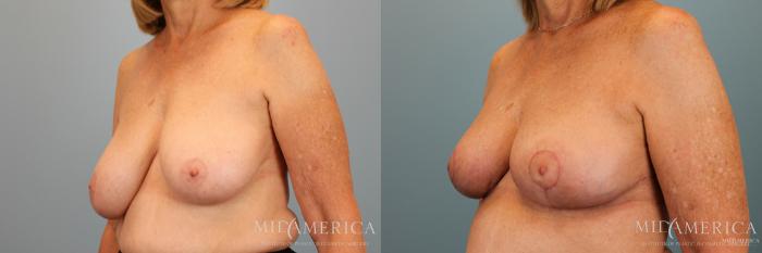 Before & After Breast Reduction Case 31 View #4 View in Glen Carbon, IL