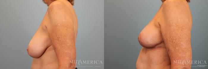 Before & After Breast Reduction Case 31 View #5 View in Glen Carbon, IL
