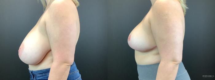 Before & After Breast Reduction Case 314 Left Side View in St. Louis, MO