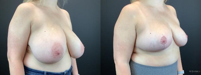Before & After Breast Reduction Case 314 Right Oblique View in St. Louis, MO