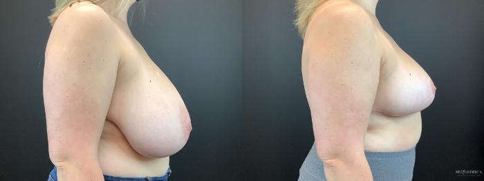 Before & After Breast Reduction Case 314 Right Side View in St. Louis, MO