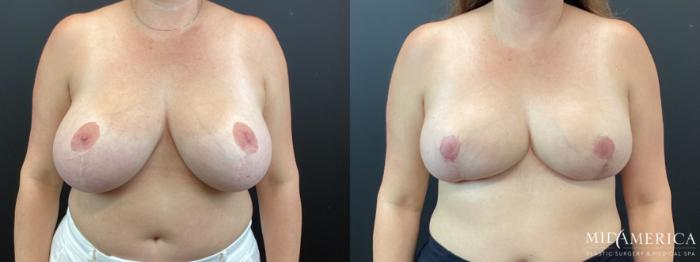 Before & After Breast Reduction Case 345 Front View in St. Louis, MO