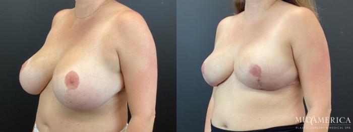 Before & After Breast Reduction Case 345 Left Oblique View in St. Louis, MO