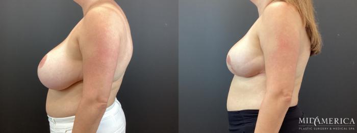 Before & After Breast Reduction Case 345 Left Side View in St. Louis, MO