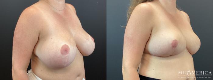 Before & After Breast Reduction Case 345 Right Oblique View in St. Louis, MO