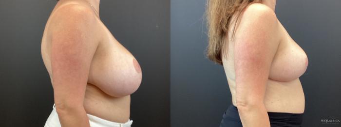 Before & After Breast Reduction Case 345 Right Side View in St. Louis, MO