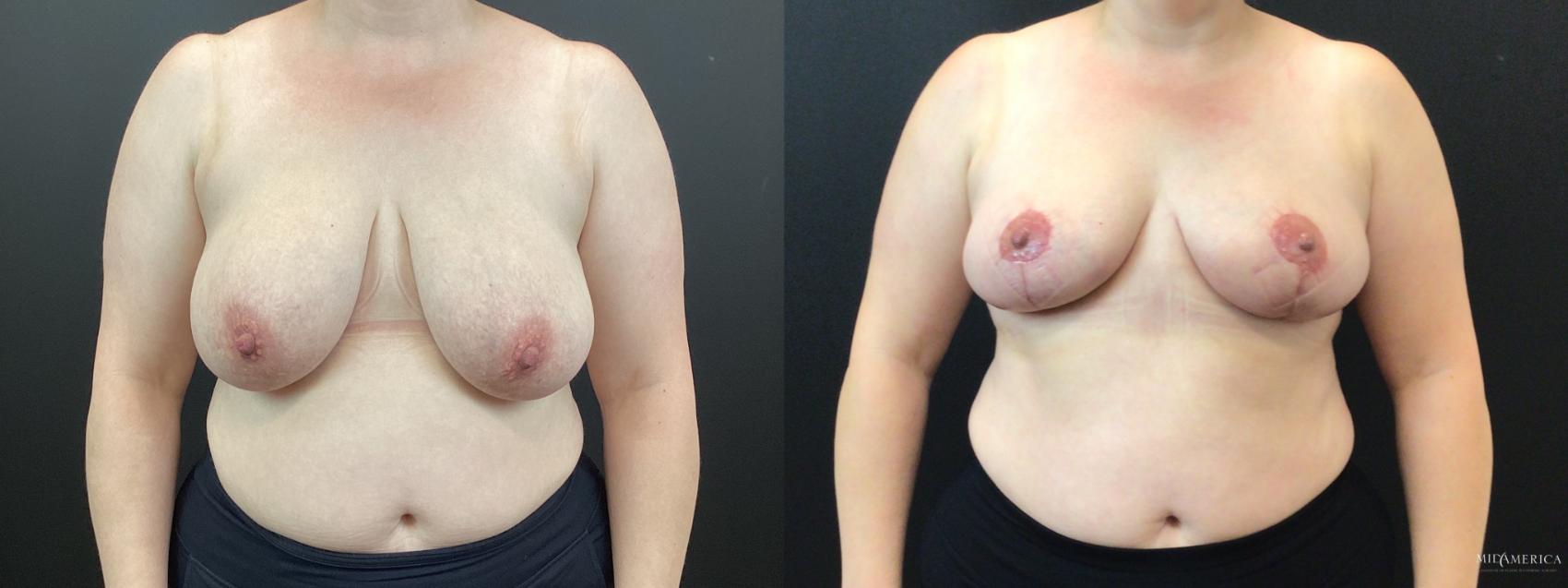 Before & After Breast Reduction Case 350 Front View in St. Louis, MO