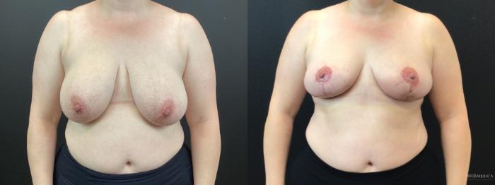 Before & After Breast Reduction Case 350 Front View in St. Louis, MO