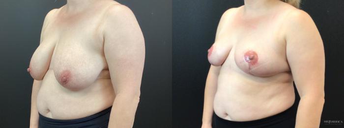 Before & After Breast Reduction Case 350 Left Oblique View in St. Louis, MO