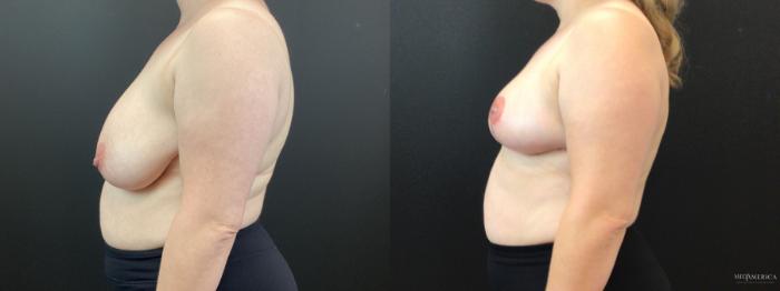 Before & After Breast Reduction Case 350 Left Side View in St. Louis, MO
