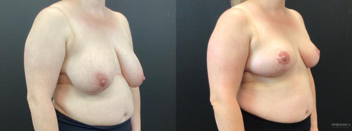 Before & After Breast Reduction Case 350 Right Oblique View in St. Louis, MO
