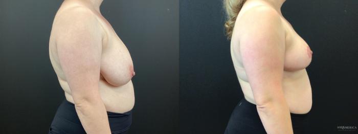 Before & After Breast Reduction Case 350 Right Side View in St. Louis, MO