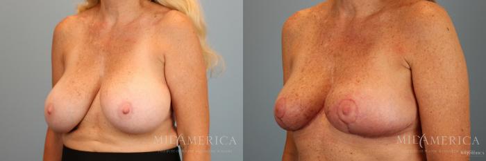 Before & After Breast Reduction Case 37 View #2 View in Glen Carbon, IL