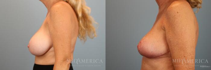 Before & After Breast Reduction Case 37 View #3 View in Glen Carbon, IL