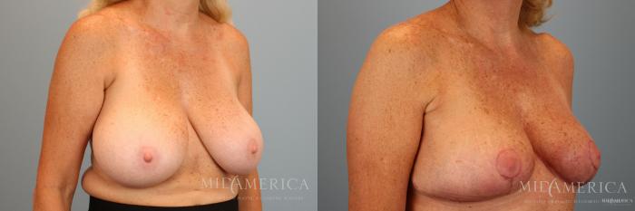 Before & After Breast Reduction Case 37 View #4 View in Glen Carbon, IL