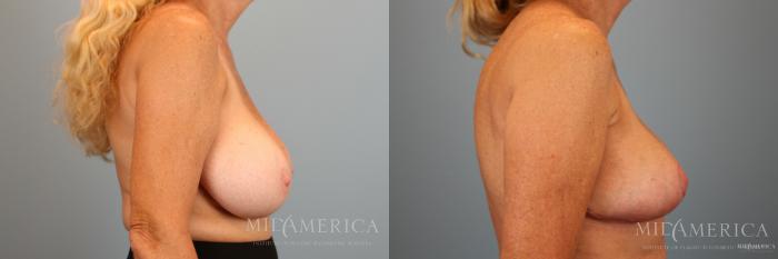 Before & After Breast Reduction Case 37 View #5 View in Glen Carbon, IL