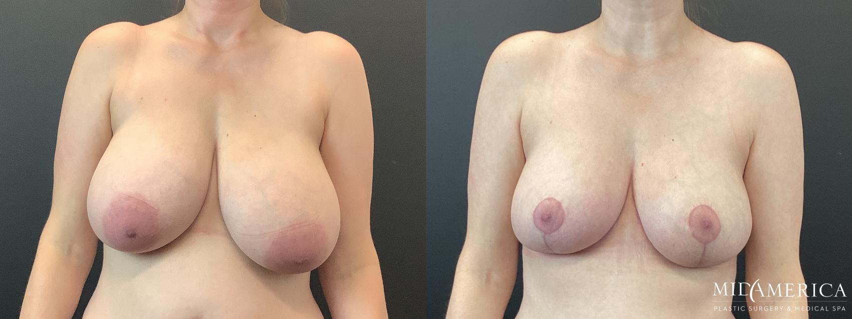 Before & After Breast Reduction Case 388 Front View in St. Louis, MO