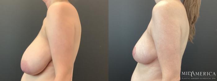 Before & After Breast Reduction Case 388 Left Side View in St. Louis, MO