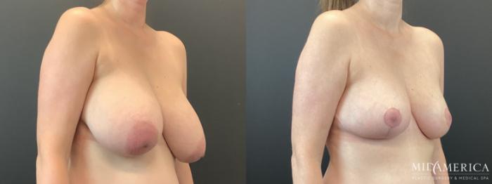 Before & After Breast Reduction Case 388 Right Oblique View in St. Louis, MO