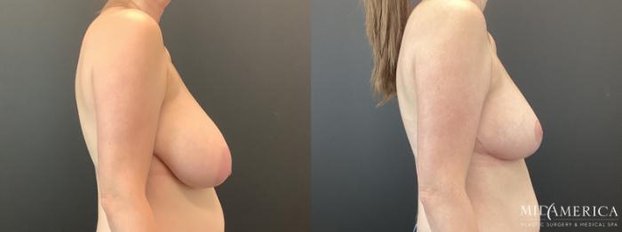 Before & After Breast Reduction Case 388 Right Side View in St. Louis, MO