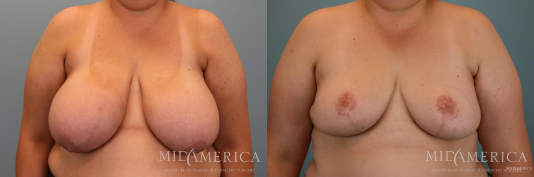 Breast Reduction Case 66 Before & After View #1 | Glen Carbon, IL | MidAmerica Plastic Surgery