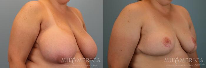 Before & After Breast Reduction Case 66 View #2 View in Glen Carbon, IL