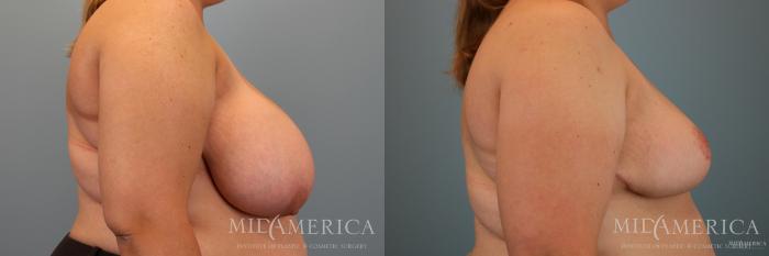Before & After Breast Reduction Case 66 View #3 View in Glen Carbon, IL
