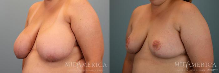 Before & After Breast Reduction Case 66 View #4 View in Glen Carbon, IL