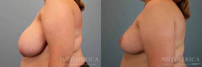 Before & After Breast Reduction Case 66 View #5 View in Glen Carbon, IL
