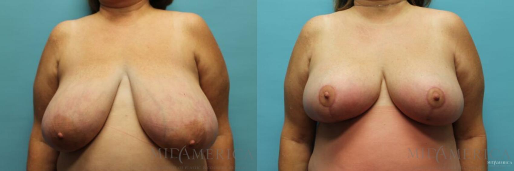 Before & After Breast Reduction Case 96 View #1 View in St. Louis, MO
