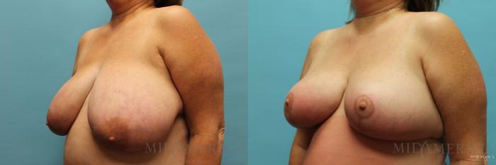 Before & After Breast Reduction Case 96 View #2 View in St. Louis, MO
