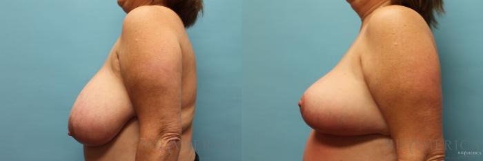 Before & After Breast Reduction Case 96 View #3 View in St. Louis, MO