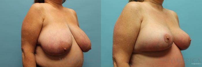 Before & After Breast Reduction Case 96 View #4 View in St. Louis, MO