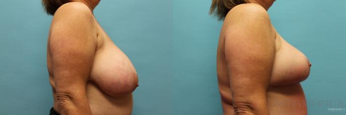 Before & After Breast Reduction Case 96 View #5 View in St. Louis, MO