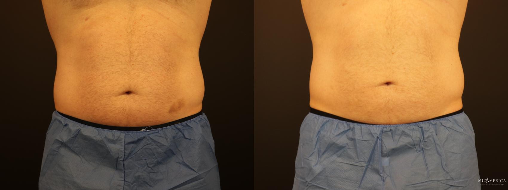 CoolSculpting Case 274 Before & After Front | Glen Carbon, IL | MidAmerica Plastic Surgery